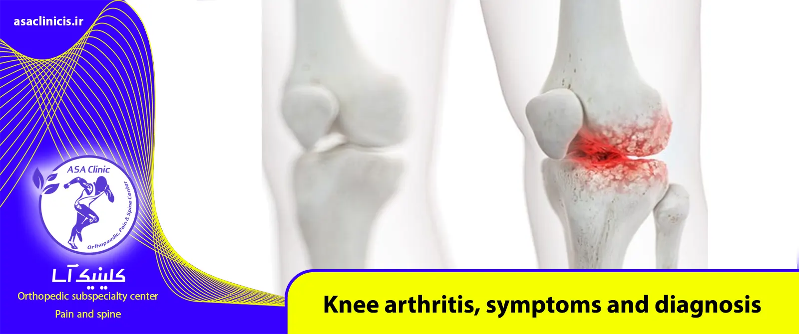 Treatment of knee arthritis and home diagnosis